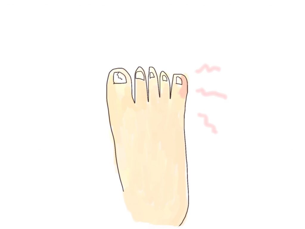 登山靴は足のトラブルも多い。
小指が痛いことや、爪が割れたこともある。